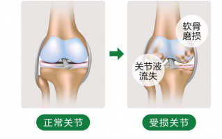 氨糖软骨素的作用能补钙吗？具体能够起到哪些作用？