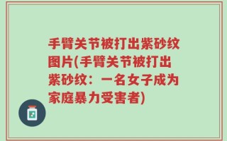 手臂关节被打出紫砂纹图片(手臂关节被打出紫砂纹：一名女子成为家庭暴力受害者)