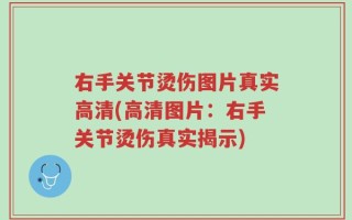 右手关节烫伤图片真实高清(高清图片：右手关节烫伤真实揭示)