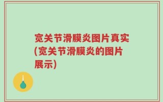 宽关节滑膜炎图片真实(宽关节滑膜炎的图片展示)