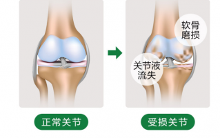 氨糖软骨素的作用能够修复关节软骨吗？