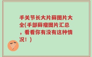 手关节长大片藓图片大全(手部藓瘤图片汇总，看看你有没有这种情况！)