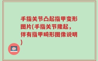 手指关节凸起指甲变形图片(手指关节隆起，伴有指甲畸形图像说明)