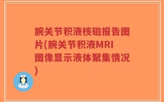 腕关节积液核磁报告图片(腕关节积液MRI图像显示液体聚集情况)