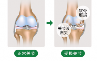 氨糖软骨素的功效和作用能治关节炎吗？
