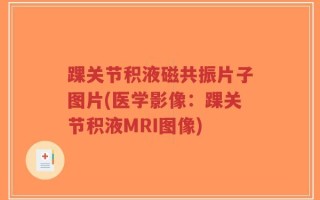 踝关节积液磁共振片子图片(医学影像：踝关节积液MRI图像)