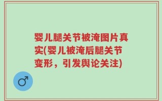 婴儿腿关节被淹图片真实(婴儿被淹后腿关节变形，引发舆论关注)