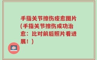 手指关节擦伤痊愈图片(手指关节擦伤成功治愈：比对前后照片看进展！)