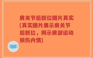 肩关节后脱位图片真实(真实图片展示肩关节后脱位，揭示肩部运动损伤内情)