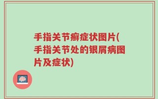 手指关节癣症状图片(手指关节处的银屑病图片及症状)