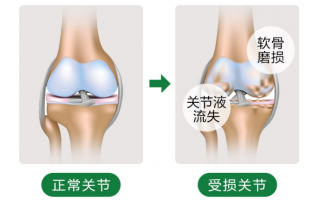 氨糖的作用可以吃哪些食物来补？