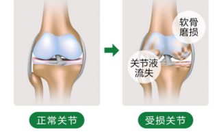 氨糖的作用能保护膝关节吗？