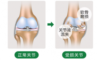 氨糖的作用还是钙的作用适合养护关节？