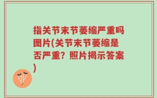 指关节末节萎缩严重吗图片(关节末节萎缩是否严重？照片揭示答案)