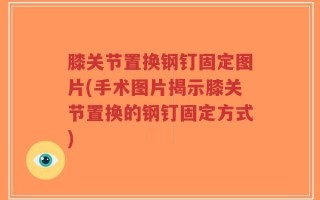 膝关节置换钢钉固定图片(手术图片揭示膝关节置换的钢钉固定方式)