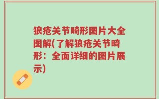 狼疮关节畸形图片大全图解(了解狼疮关节畸形：全面详细的图片展示)