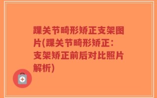踝关节畸形矫正支架图片(踝关节畸形矫正：支架矫正前后对比照片解析)