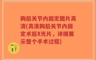 胸后关节内固定图片高清(高清胸后关节内固定术后X光片，详细展示整个手术过程)