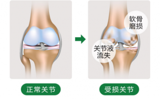 关节炎能吃氨糖吗？氨糖能够起到哪些作用？