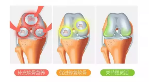 氨糖软骨素的作用能改善关节炎问题吗？-第1张图片-超越