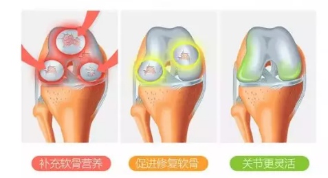 氨糖软骨素如何选？什么样的氨糖好？-第1张图片-超越