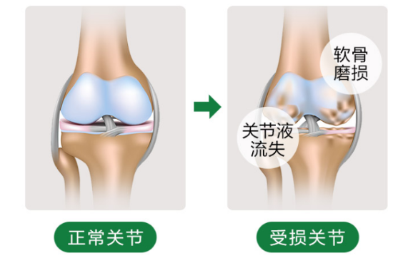关节炎能吃氨糖吗?氨糖能够起到哪些作用?-第1张图片-超越 关节炎能吃氨糖吗?氨糖能够起到哪些作用?-第1张图片-超越