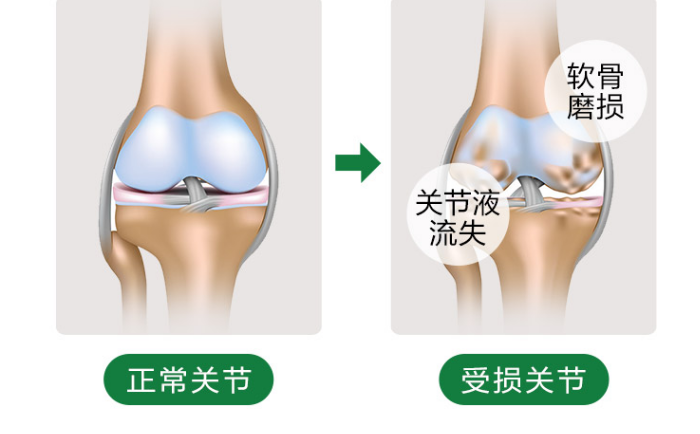 氨糖软骨素的功效和作用能治关节炎吗？-第1张图片-超越
