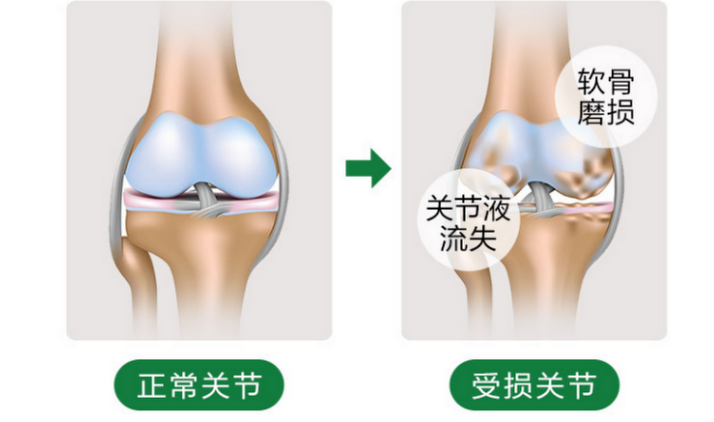 氨糖软骨素的作用对年轻人有用吗？-第1张图片-超越