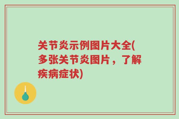 关节炎示例图片大全(多张关节炎图片,了解疾病症状)-第1张图片-超越 关节炎示例图片大全(多张关节炎图片,了解疾病症状)-第1张图片-超越