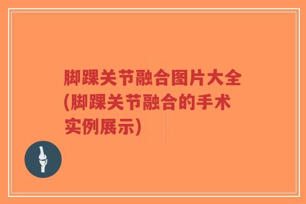 脚踝关节融合图片大全(脚踝关节融合的手术实例展示)-第1张图片-超越 脚踝关节融合图片大全(脚踝关节融合的手术实例展示)-第1张图片-超越