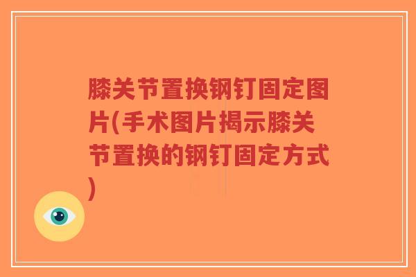膝关节置换钢钉固定图片(手术图片揭示膝关节置换的钢钉固定方式)-第1张图片-超越 膝关节置换钢钉固定图片(手术图片揭示膝关节置换的钢钉固定方式)-第1张图片-超越